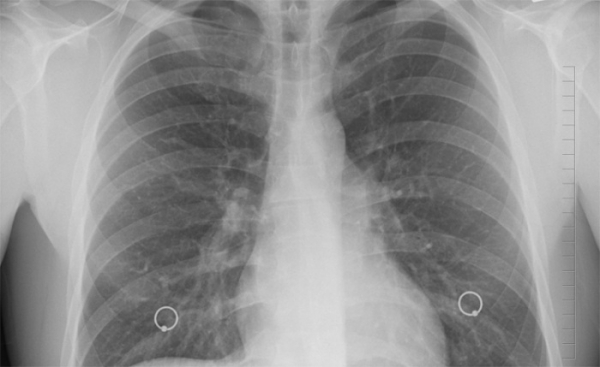 Plicní lékaři odhalili ve Zlínském kraji 5 nemocných 